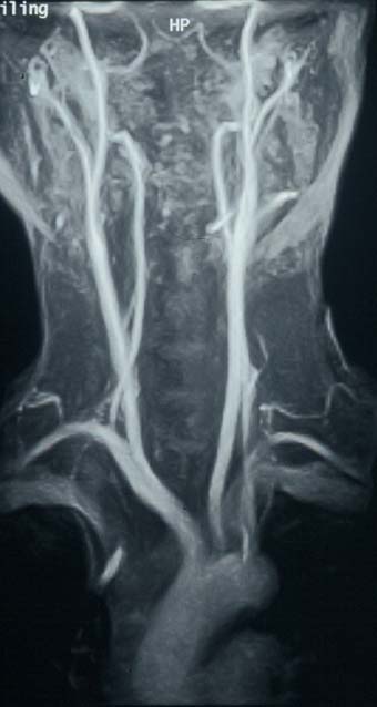 An MRA scan of carotid arteries