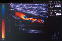 A scan of a narrowing in the superficial femoral artery