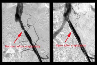 Angioplasty of left common iliac artery