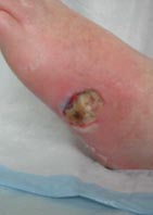 ischemic foot ulcer
